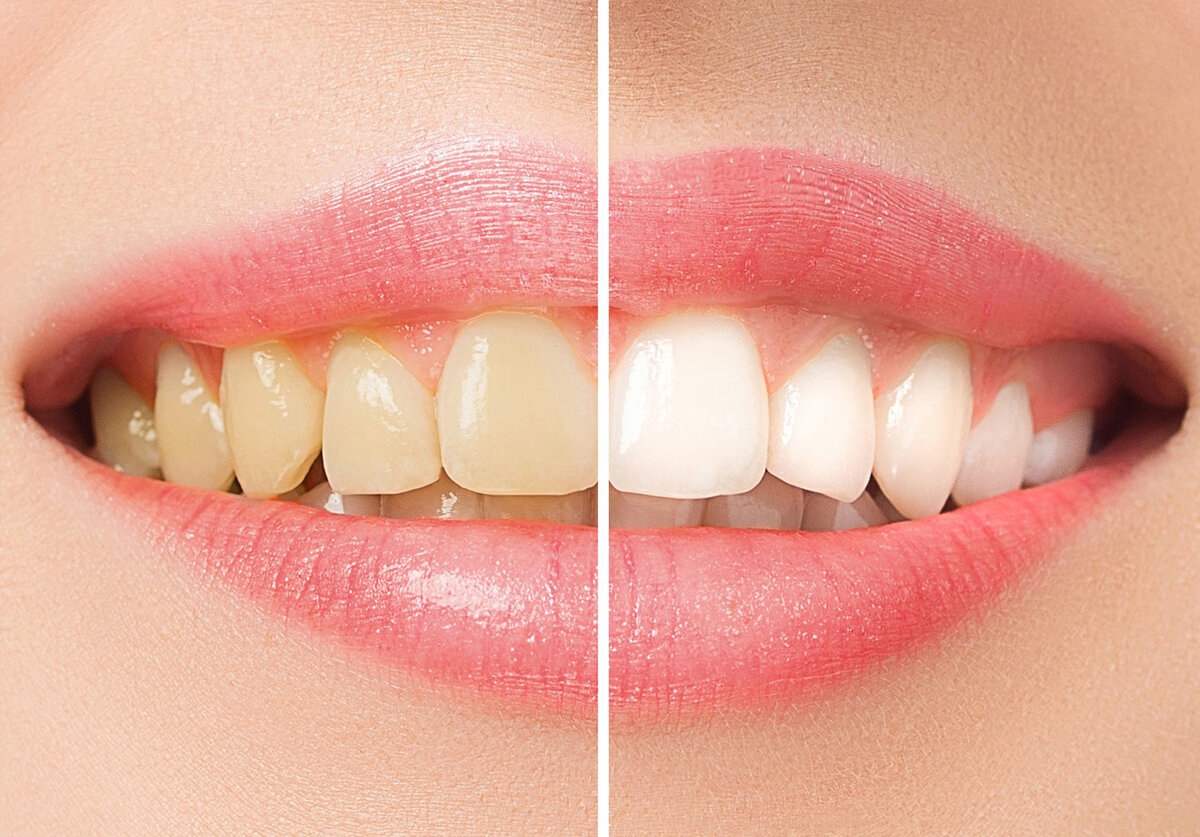 Как отбелить зубы дома: на 3 тона светлее