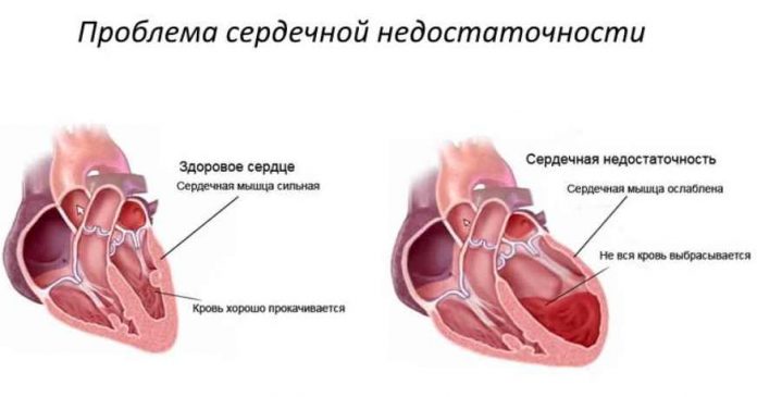 Как избавиться от сердечной одышки