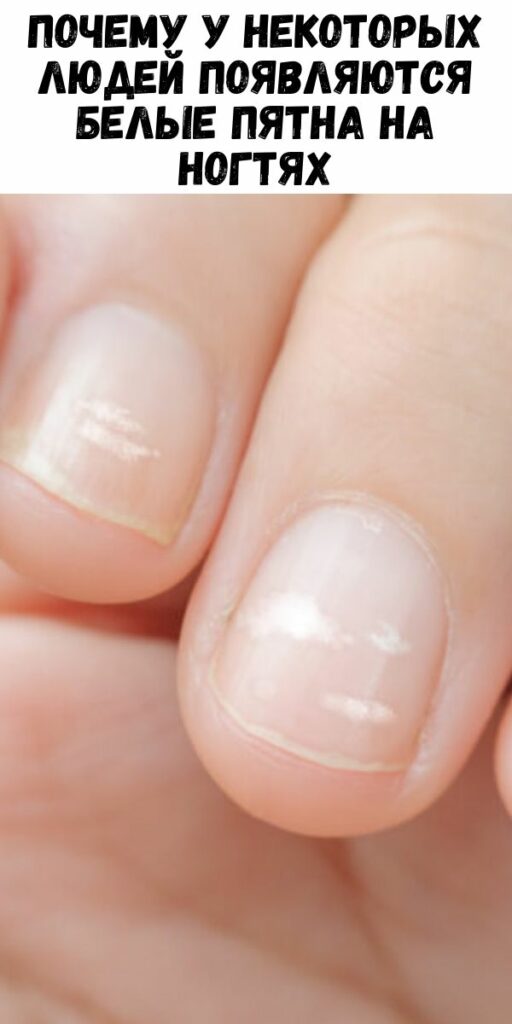 Почему у некоторых людей появляются белые пятна на ногтях
