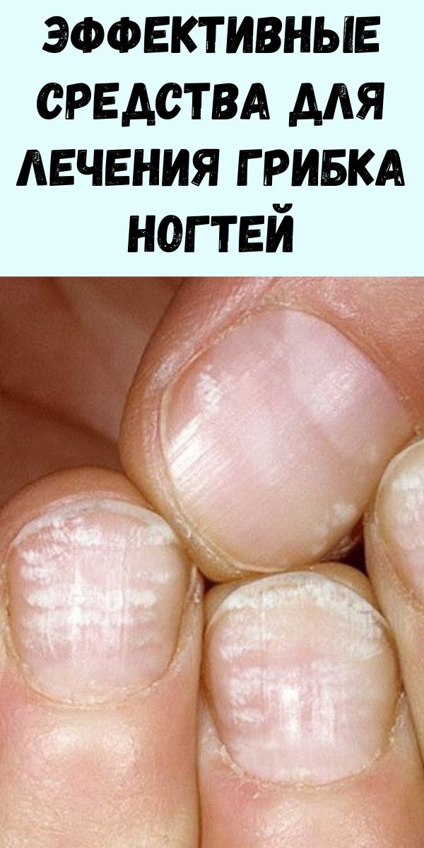 Эффективные средства для лечения грибка ногтей
