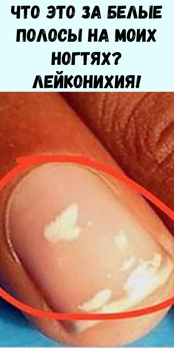 Что это за белые полосы на моих ногтях? Лейконихия!