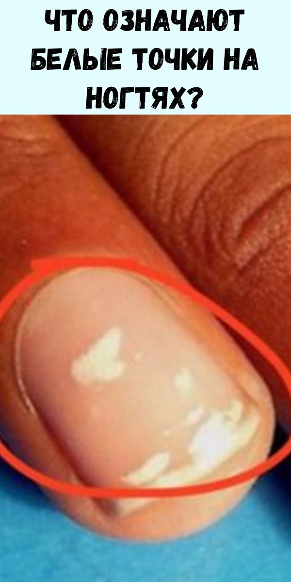 Что означают белые точки на ногтях?