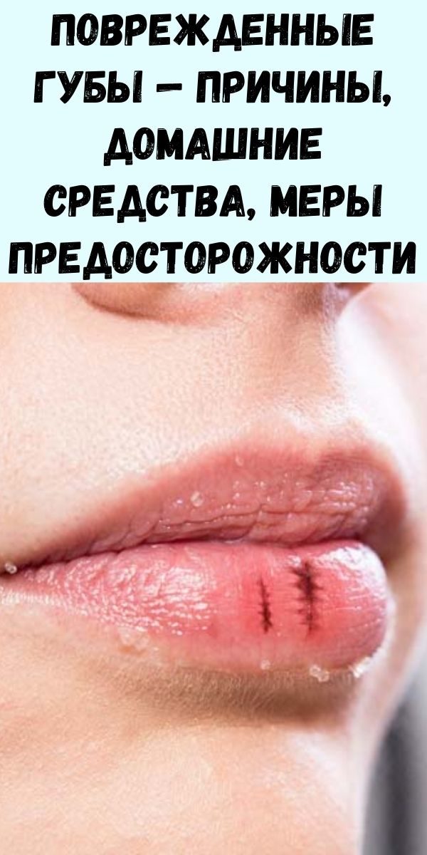 Поврежденные губы - причины, домашние средства, меры предосторожности