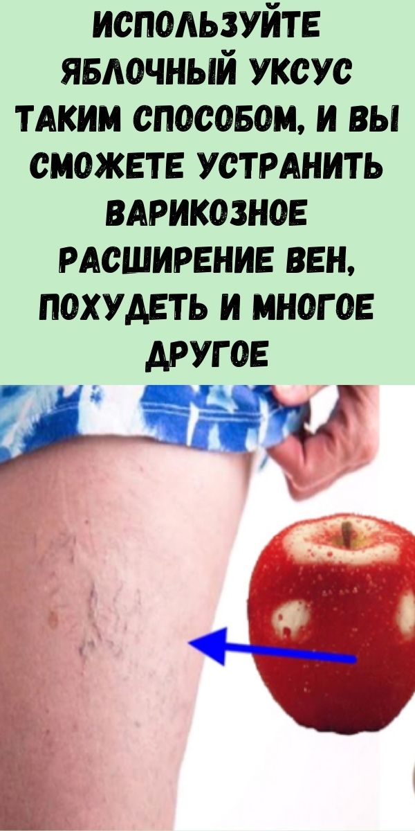 Используйте яблочный уксус таким способом, и вы сможете устранить варикозное расширение вен, похудеть и многое другое