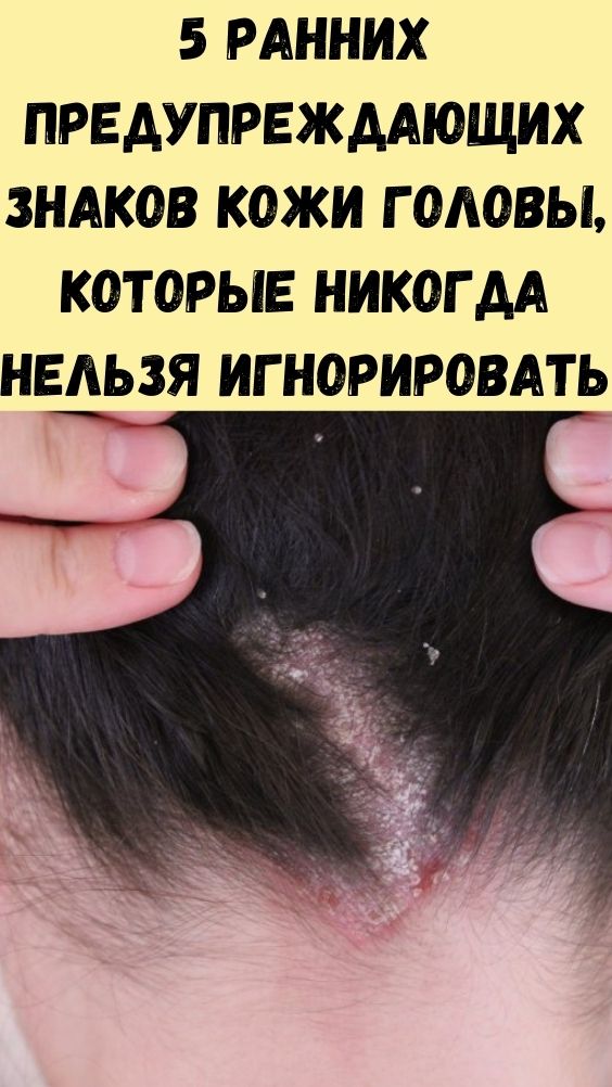 5 ранних предупреждающих знаков кожи головы, которые никогда нельзя игнорировать